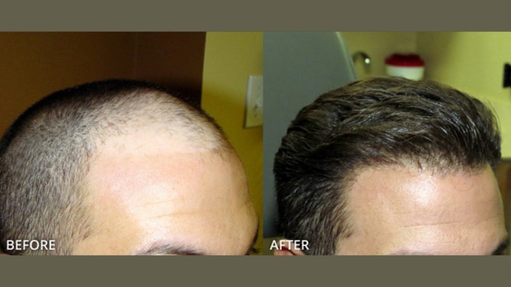 Affordable FUE Hair Transplant treatments