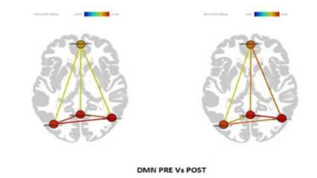 Supervised mindfulness meditation benefits patients with Mild Cognitive Impairment and early Alzheimer’s disease 